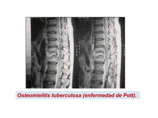 Osteomielitis tuberculosa (enfermedad de Pott).
 