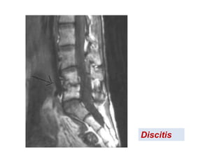 Discitis
 