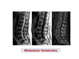 Metástasis Vertebrales
 