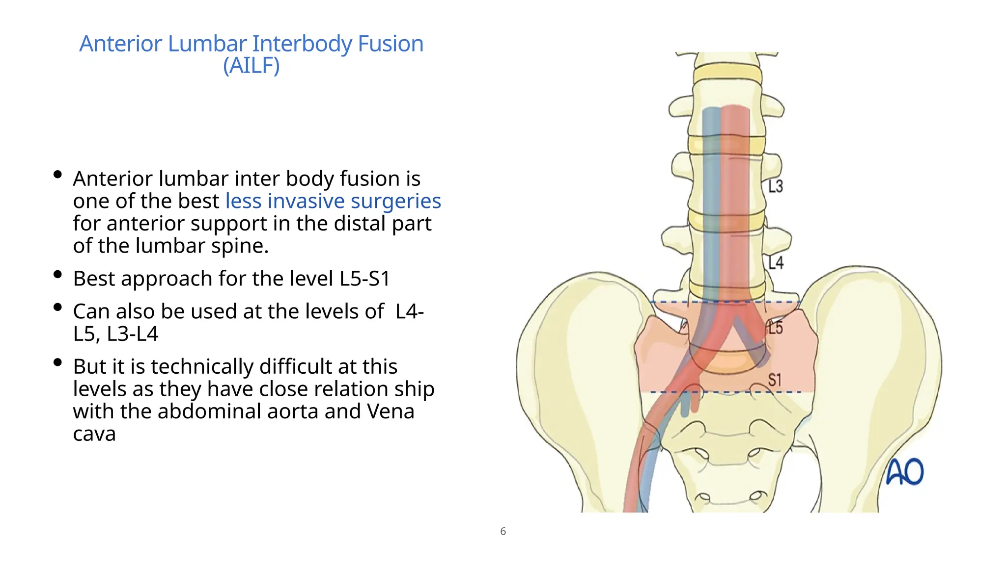 lumbar interbody fusion 3.pptx clinical features treatment | PPTX ...