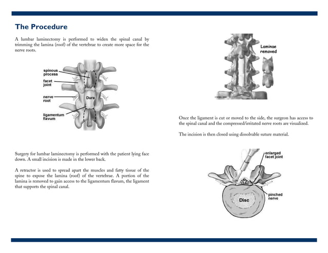 Lumbar Laminectomy | PDF | Physical Therapy | Wellness