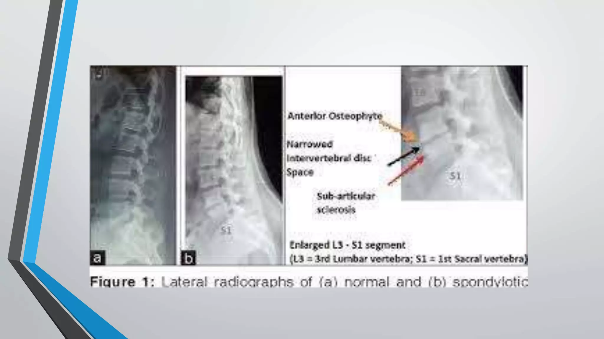 Lumbar Pathologies Lumbar Pathologies.pptx