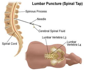 Lumbar Puncture