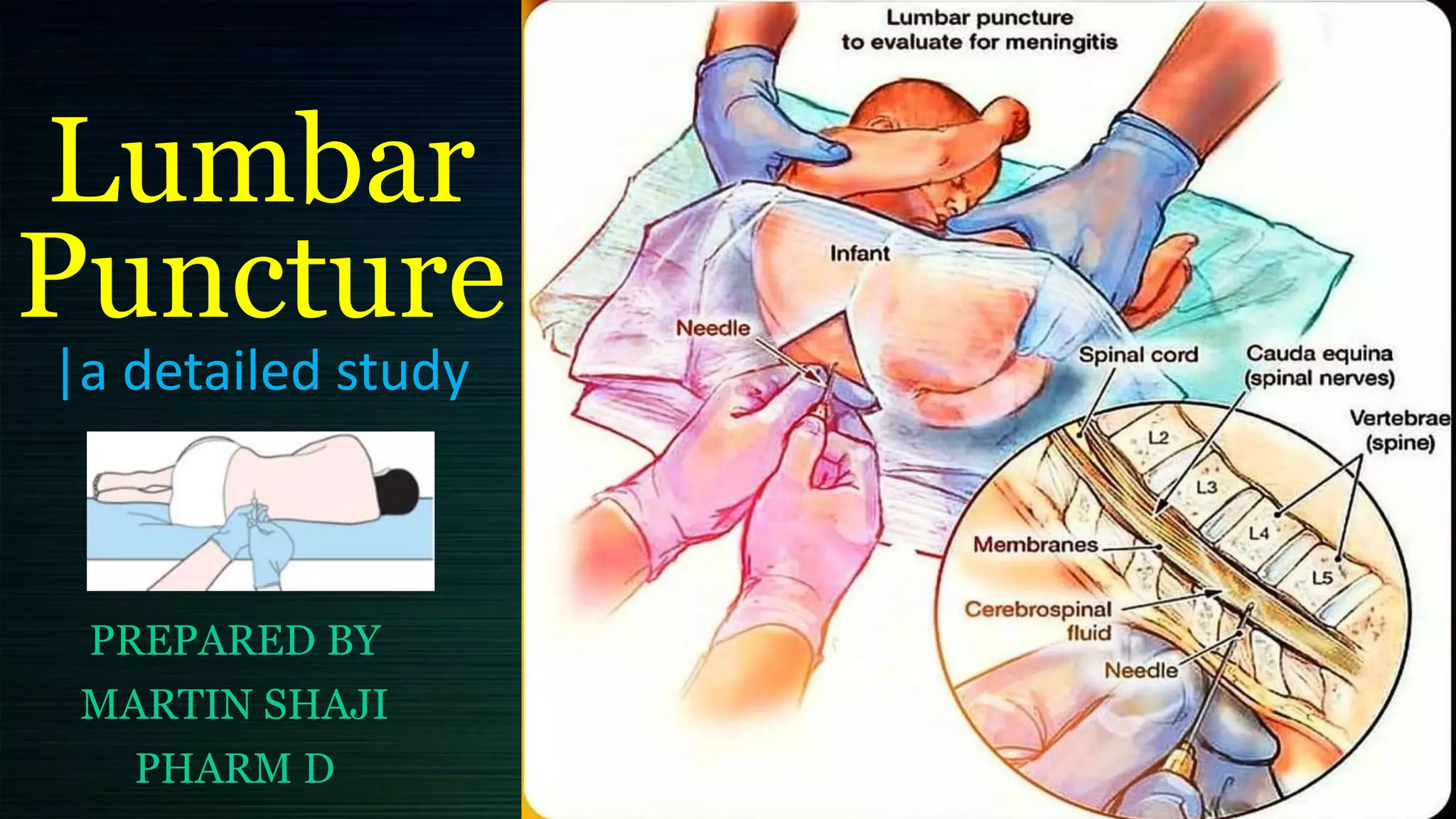 Window Puncture Lumbar puncture - a detailed medical study | all aspects of lumbar ...