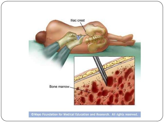 Lumbar puncture and bone marrow aspiration