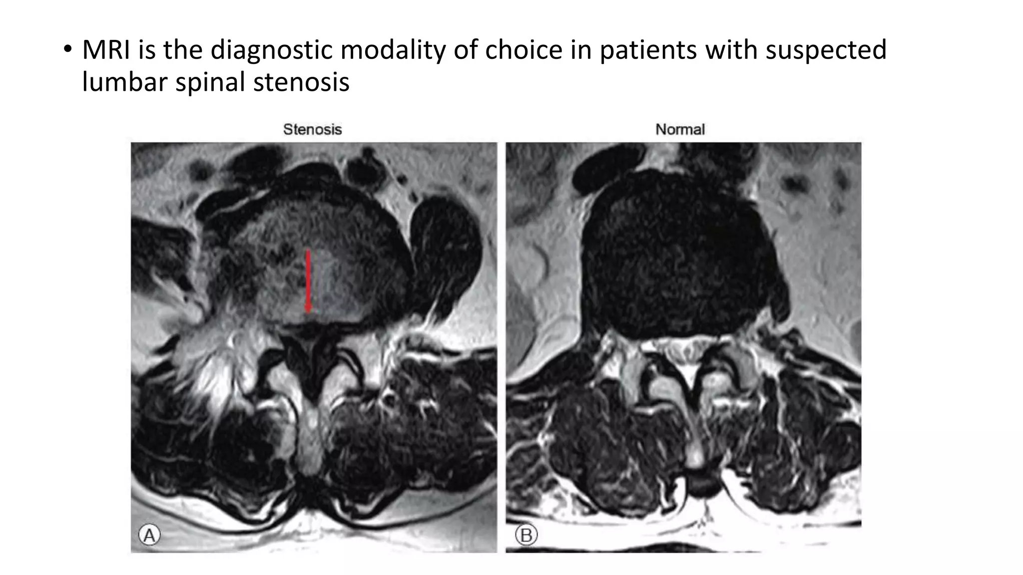 Lumbar spinal stenosis | PPTX