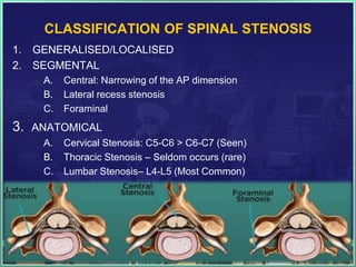 Disc Prolapse Classification Lumbar spinal stenosis, laminectomy, prolapsed intervertebral disc | PPTX