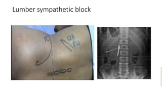 Lumber sympathetic block
 