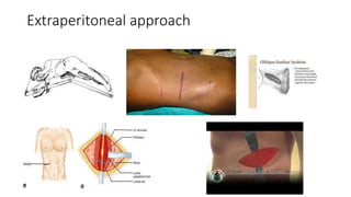 Extraperitoneal approach
 