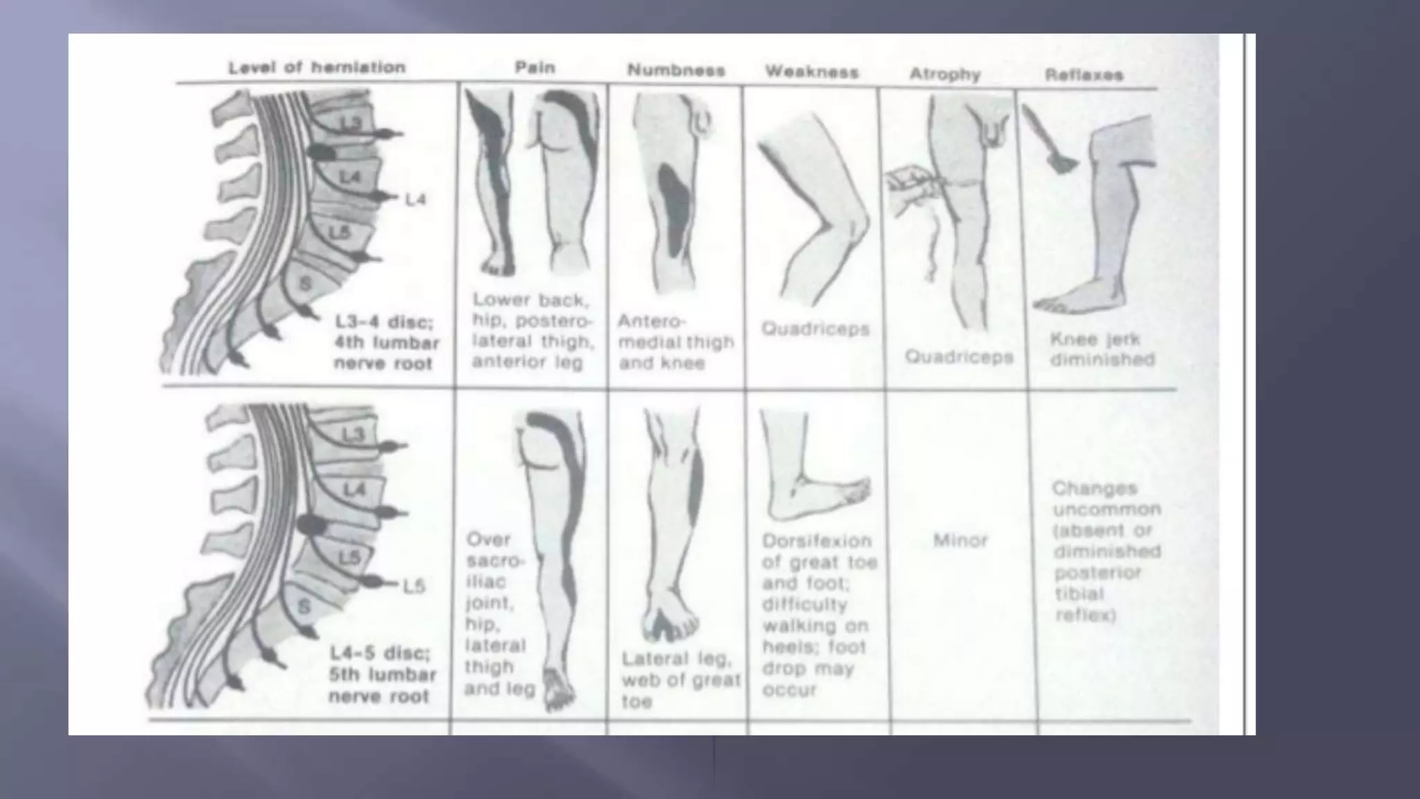 Disc Prolapse Classification Lumber disc bulge/ Herniation/ Prolapse | PPTX