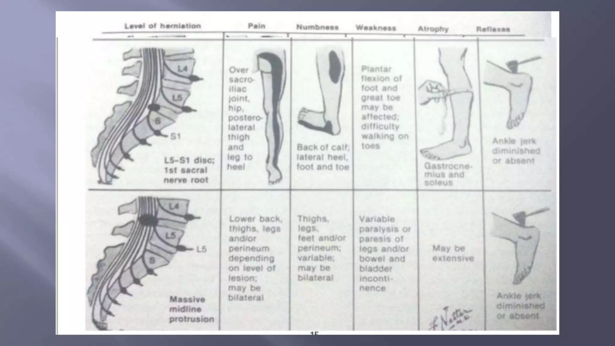 Disc Prolapse Classification Lumber disc bulge/ Herniation/ Prolapse | PPTX