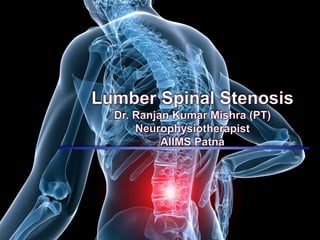 Lumbar spinal stenosis | PPTX