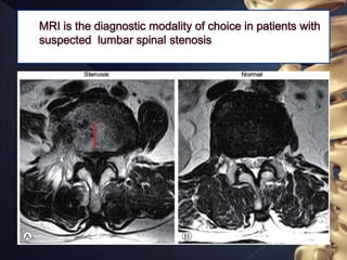 Lumbar spinal stenosis | PPTX