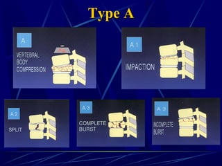 Dcapblstic Lumbar Injuries | PPT