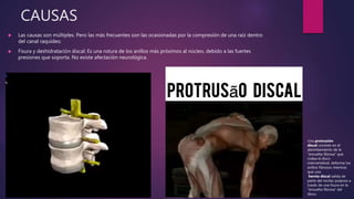 CAUSAS
 Las causas son múltiples. Pero las más frecuentes son las ocasionadas por la compresión de una raíz dentro
del canal raquídeo.
 Fisura y deshidratación discal: Es una rotura de los anillos más próximos al núcleo, debido a las fuertes
presiones que soporta. No existe afectación neurológica.
Una protrusión
discal consiste en el
abombamiento de la
“envuelta fibrosa” que
rodea el disco
intervertebral, deforma los
anillos fibrosos mientras
que una
hernia discal salida de
parte del núcleo pulposo a
través de una fisura en la
“envuelta fibrosa” del
disco.
Hernia discal.
 