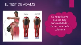 EL TEST DE ADAMS
Es negativa ya
que no hay
anormalidades
de la curva de la
columna
 