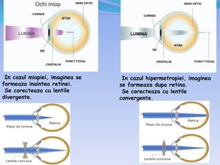 In cazul miopiei, imaginea se    In cazul hipermetropiei, imaginea
formeaza inaintea retinei.       se formeaza dupa retina.
 Se corecteaza cu lentile         Se corecteaza cu lentile
divergente.                      convergente.
 