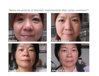Below are pictures of dramatic improvements after using Luminesce™
 