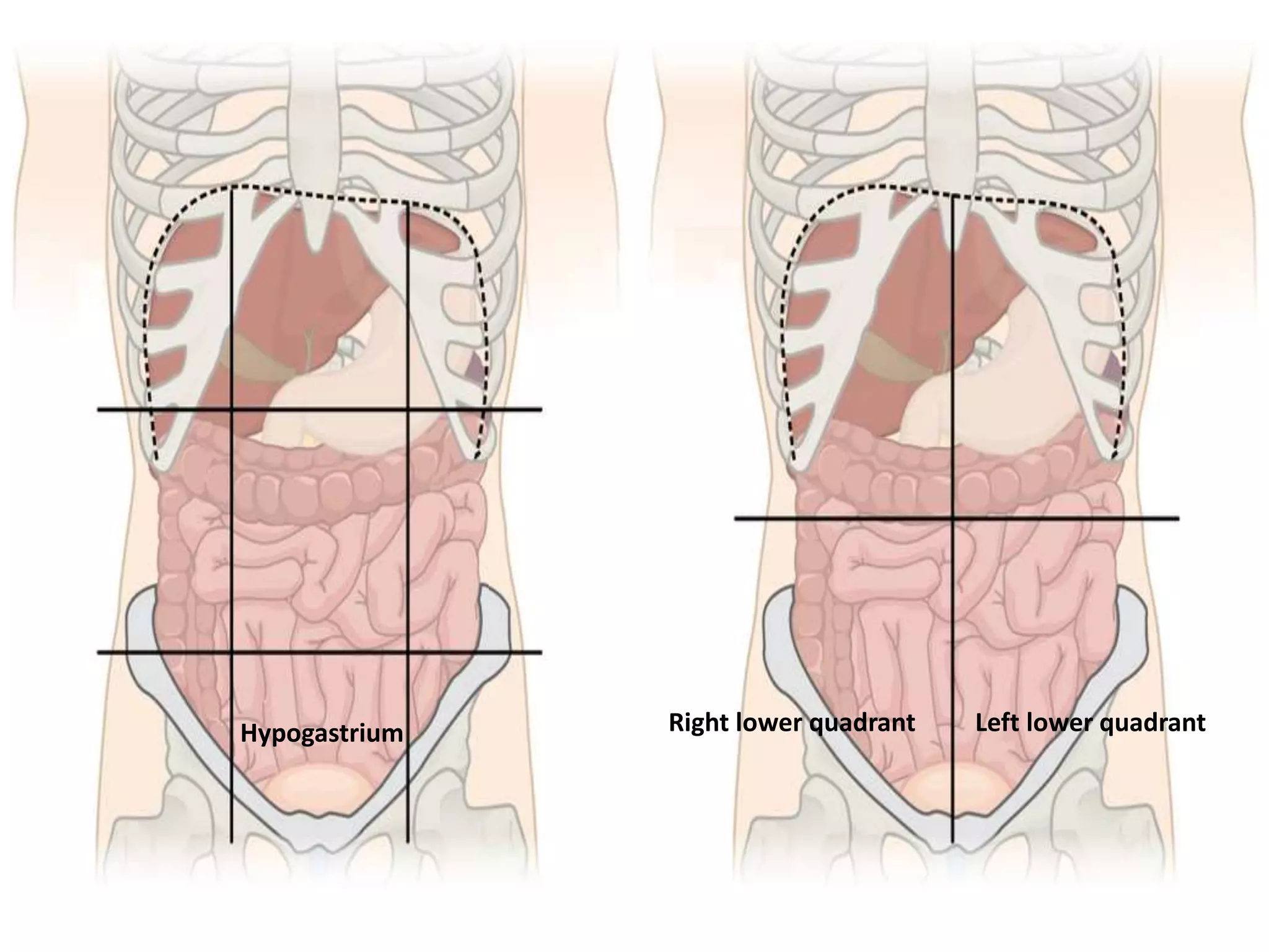 Left Submentrum Lump abdomen | PPTX