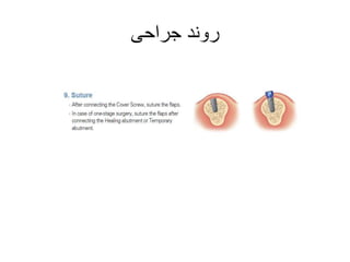 Luna dental implant principles