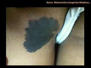 Nevus Melanocítico Congénito Mediano…
 