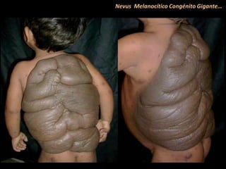 Nevus Melanocítico Congénito Gigante…
 