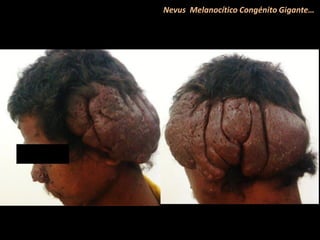 Nevus Melanocítico Congénito Gigante…
 