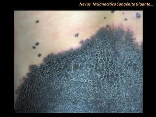 Nevus Melanocítico Congénito Gigante…
 