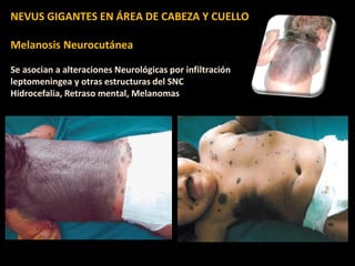 NEVUS GIGANTES EN ÁREA DE CABEZA Y CUELLO
Melanosis Neurocutánea
Se asocian a alteraciones Neurológicas por infiltración
leptomeningea y otras estructuras del SNC
Hidrocefalia, Retraso mental, Melanomas
 