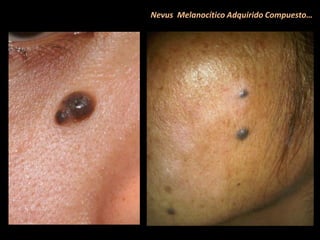 Nevus Melanocítico Adquirido Compuesto…
 