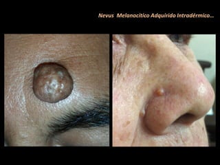 Nevus Melanocítico Adquirido Intradérmico…
 