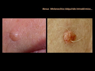 Nevus Melanocítico Adquirido Intradérmico…
 