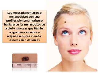 Los nevus pigmentarios o
melanociticos son una
proliferación anormal pero
benigna de los melanocitos de
la piel y mucosas que tienden
a agruparse en nidos y
originan maculas marrón-
oscuras bien definidas
 