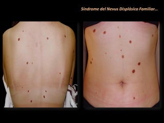 Síndrome del Nevus Displásico Familiar…
 