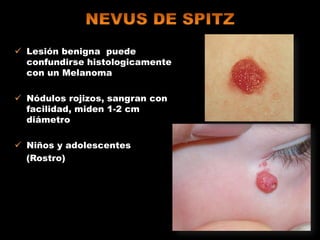  Lesión benigna puede
confundirse histologicamente
con un Melanoma
 Nódulos rojizos, sangran con
facilidad, miden 1-2 cm
diámetro
 Niños y adolescentes
(Rostro)
 