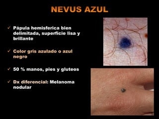  Pápula hemisferica bien
delimitada, superficie lisa y
brillante
 Color gris azulado o azul
negro
 50 % manos, pies y gluteos
 Dx diferencial: Melanoma
nodular
 