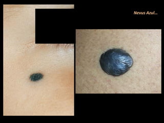 Nevus Azul…
 