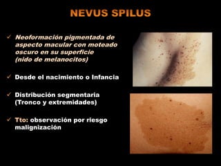  Neoformación pigmentada de
aspecto macular con moteado
oscuro en su superficie
(nido de melanocitos)
 Desde el nacimiento o Infancia
 Distribución segmentaria
(Tronco y extremidades)
 Tto: observación por riesgo
malignización
 