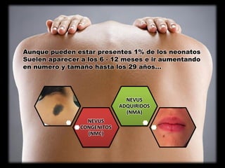 Aunque pueden estar presentes 1% de los neonatos
Suelen aparecer a los 6 - 12 meses e ir aumentando
en número y tamaño hasta los 29 años…
NEVUS
CONGENITOS
(NMC)
NEVUS
ADQUIRIDOS
(NMA)
 