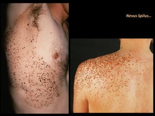 Nevus Spilus…
 