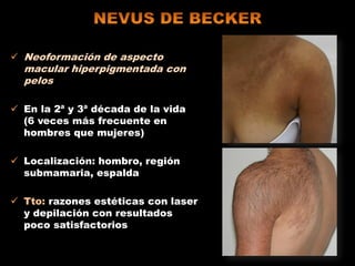  Neoformación de aspecto
macular hiperpigmentada con
pelos
 En la 2ª y 3ª década de la vida
(6 veces más frecuente en
hombres que mujeres)
 Localización: hombro, región
submamaria, espalda
 Tto: razones estéticas con laser
y depilación con resultados
poco satisfactorios
 