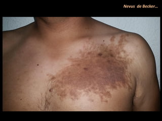 Nevus de Becker…
 
