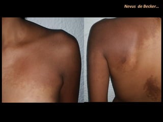 Nevus de Becker…
 