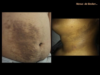 Nevus de Becker…
 