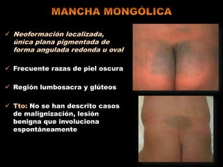  Neoformación localizada,
única plana pigmentada de
forma angulada redonda u oval
 Frecuente razas de piel oscura
 Región lumbosacra y glúteos
 Tto: No se han descrito casos
de malignización, lesión
benigna que involuciona
espontáneamente
 