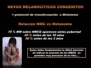 > potencial de transformación a Melanoma
70 % MM sobre NMCG aparecen antes pubertad
60 % antes de los 10 años
50 % antes de los 3 años
Estos datos fundamentan la difícil decisión
de indicar la exéresis de los NMCG en
periodos muy precoses de la vida….
 