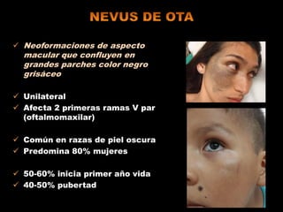  Neoformaciones de aspecto
macular que confluyen en
grandes parches color negro
grisáceo
 Unilateral
 Afecta 2 primeras ramas V par
(oftalmomaxilar)
 Común en razas de piel oscura
 Predomina 80% mujeres
 50-60% inicia primer año vida
 40-50% pubertad
 