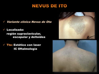  Variante clínica Nevus de Ota
 Localizada:
región supraclavicular,
escapular y deltoidea
 Tto: Estético con laser
IC Oftalmología
 