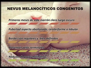 Primeros meses de vida marrón claro luego oscuro
Pubertad aspecto abollonado, cerebriforme o lobular
Bordes son regulares y bien definidos
Presentan pelos terminales
Nódulos de pocos milímetros
 
