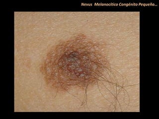 Nevus Melanocítico Congénito Pequeño…
 